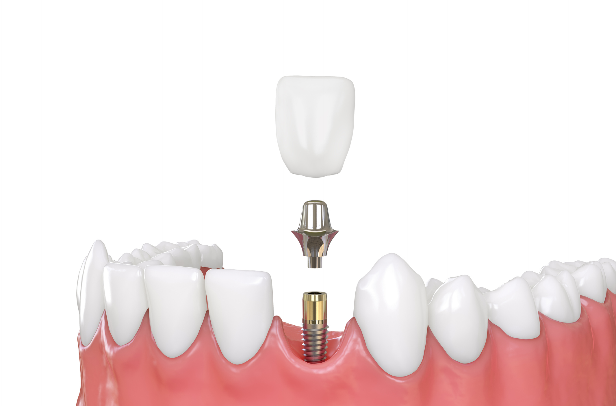 implantes dentales en Alcorcón